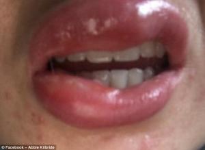 Woman is left with third-degree BURNS after a botched teeth whitening treatment