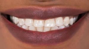 'Tooth repair drug' may replace fillings