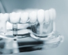 Սեփական ատամի վերականգնումը՝ ատամնաբուժության հեռանկարում
