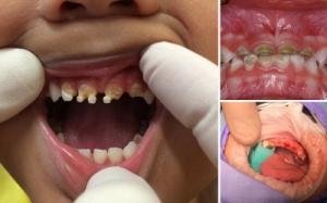 Shocking images reveal children as young as 18 MONTHS are having surgery for rotting teeth