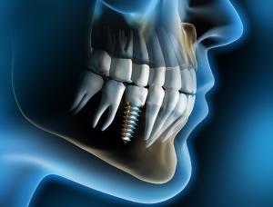 Бояться ли имплантации зубов?