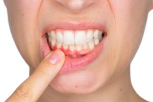 Periodontal disease increases cancer risk