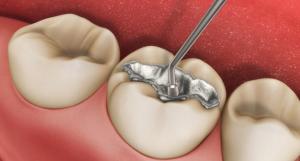 Smoking and drinking alcohol may cause failures in dental fillings