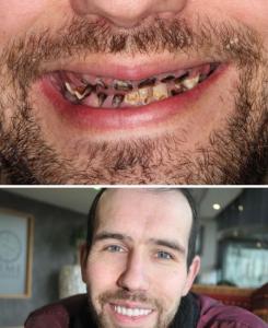 Shocking photos show what drinking six litres of fizzy pop every day did to man's teeth