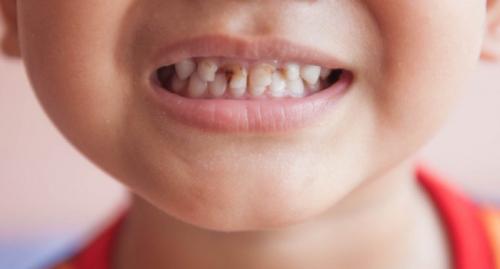 Почему у детей так часто портятся зубы и что с этим делать?