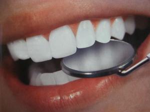 Ի՞նչ է անհրաժեշտ իմանալ ատամների սպիտակեցման մասին