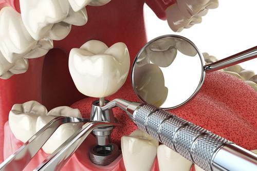 Какие опасности могут таиться в зубных имплантах