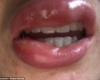 Woman is left with third-degree BURNS after a botched teeth whitening treatment