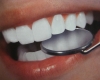 Ի՞նչ է անհրաժեշտ իմանալ ատամների սպիտակեցման մասին