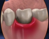 Պարոդոնտիտի  առաջին նշանը հետևյալն է. ատամների մաքրման ընթացքում լնդերը սկսում են արնահոսել
