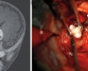 4 ամսական երեխայի ուղեղում հայտնաբերել են ձևավորված ատամներ